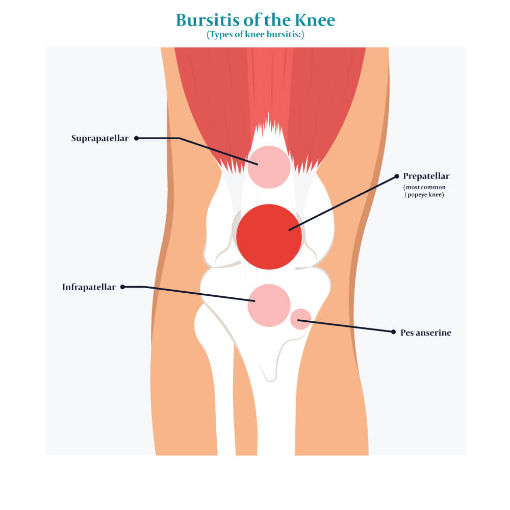 Knee Bursitis All You Need To Know Centeno Schultz Clinic