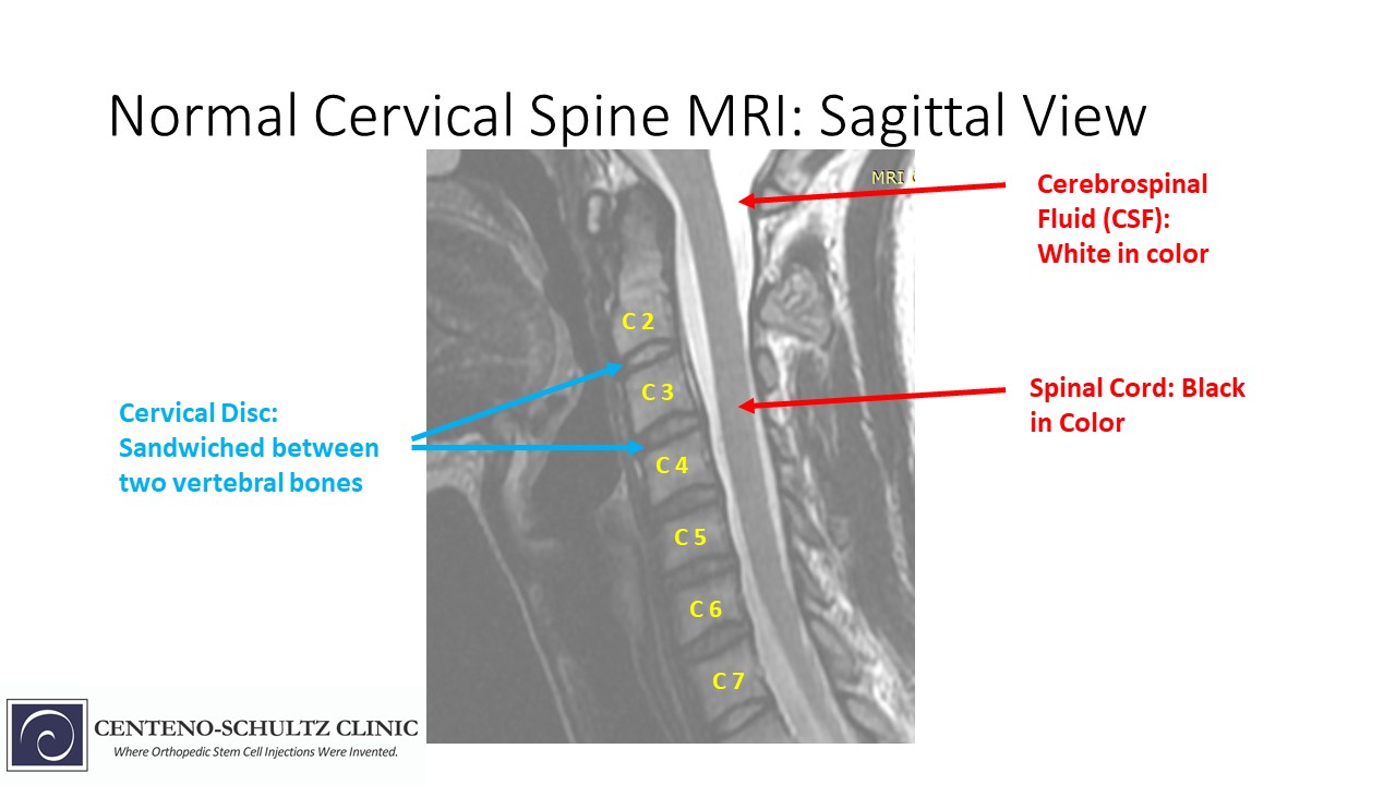 normal vs abnormal Cervical MRI