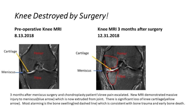 How A Meniscectomy Destroyed A Patient S Knee And Hope