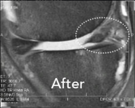 MRI - After the Perc-MTI procedure - the trusted alternative to meniscus surgery