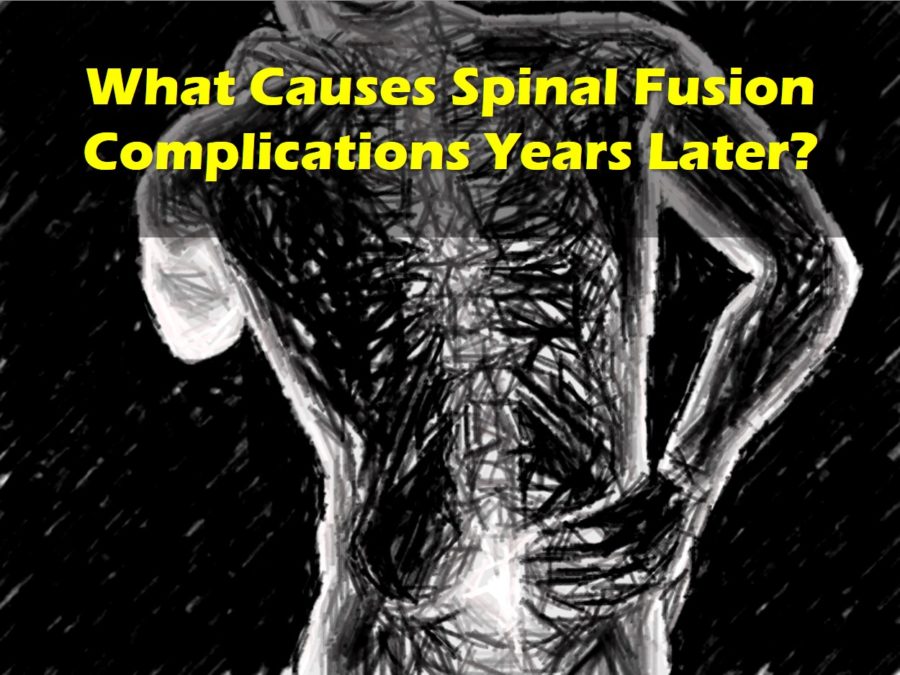 spinal fusion complications years later