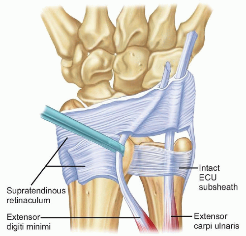 tendonitis - wrist pain