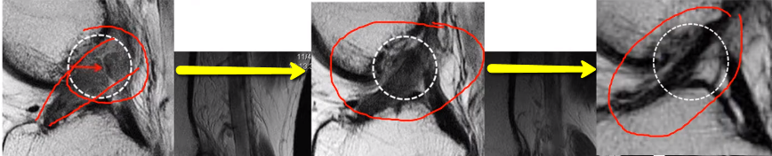 MRI morphology of ACL healing after stem cell treatment