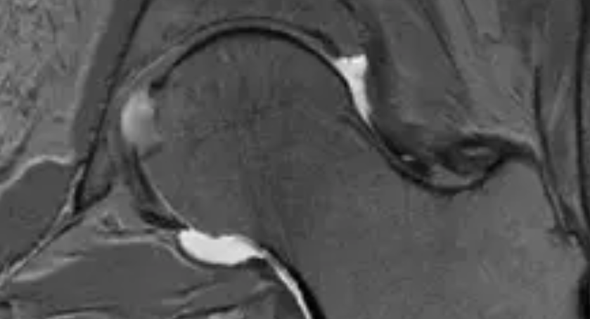 Early Detection of Avascular Necrosis of Femoral Head