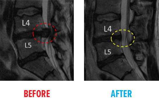 Spine MRI: Before and After - Centeno-Schultz Clinic