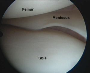 Arthroscopic view of knee