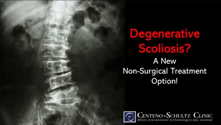 Degenerative Scoliosis Exciting New Non Surgical Treatment Option 9584