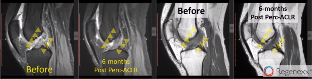 MRI evidence for acl repair at Centeno-Schultz Clinic