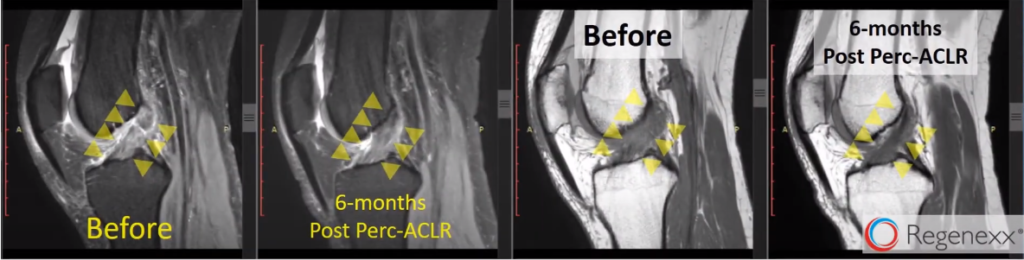 ACL Ruptured - All You Need to Know - Centeno-Schultz Clinic