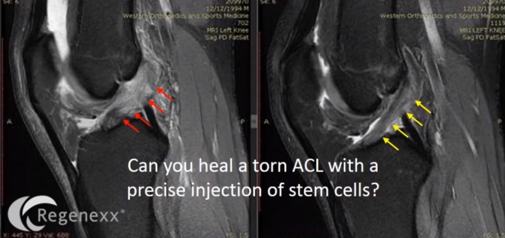 ACL Ruptured - All You Need to Know - Centeno-Schultz Clinic