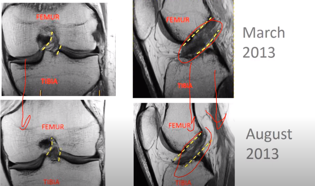 ACL Ruptured - All You Need to Know - Centeno-Schultz Clinic