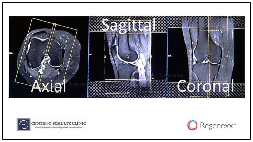 How to Read a Knee MRI for Meniscal Tear - Oanhthai