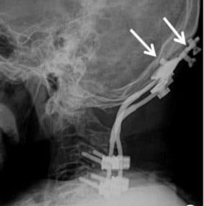 craniocervical instability