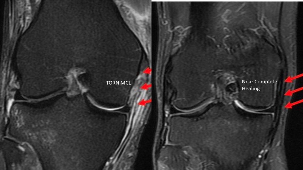 MCL Injury, MCL Surgery