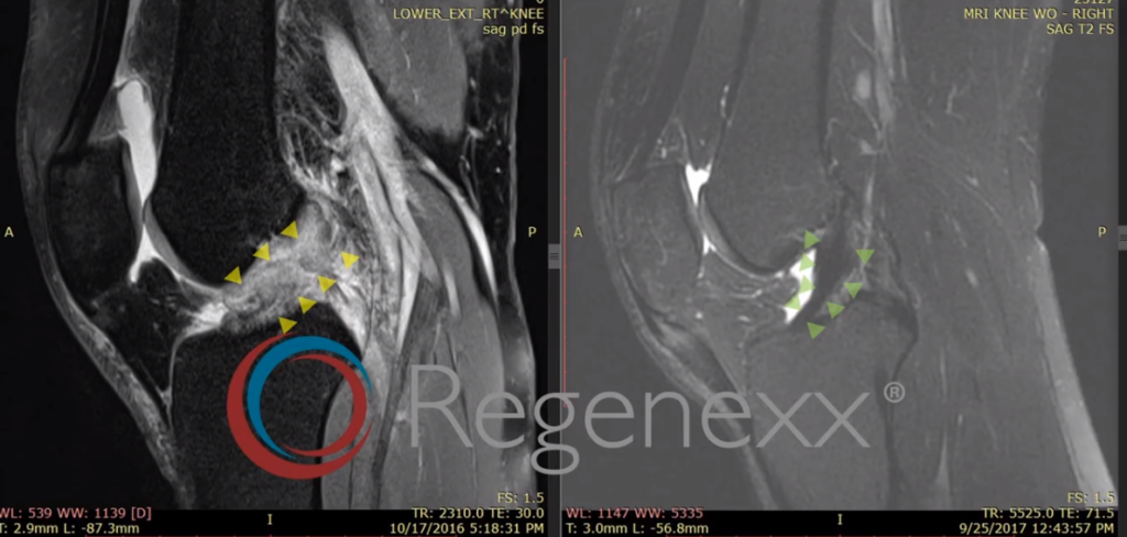 ACL MRI - Before and after