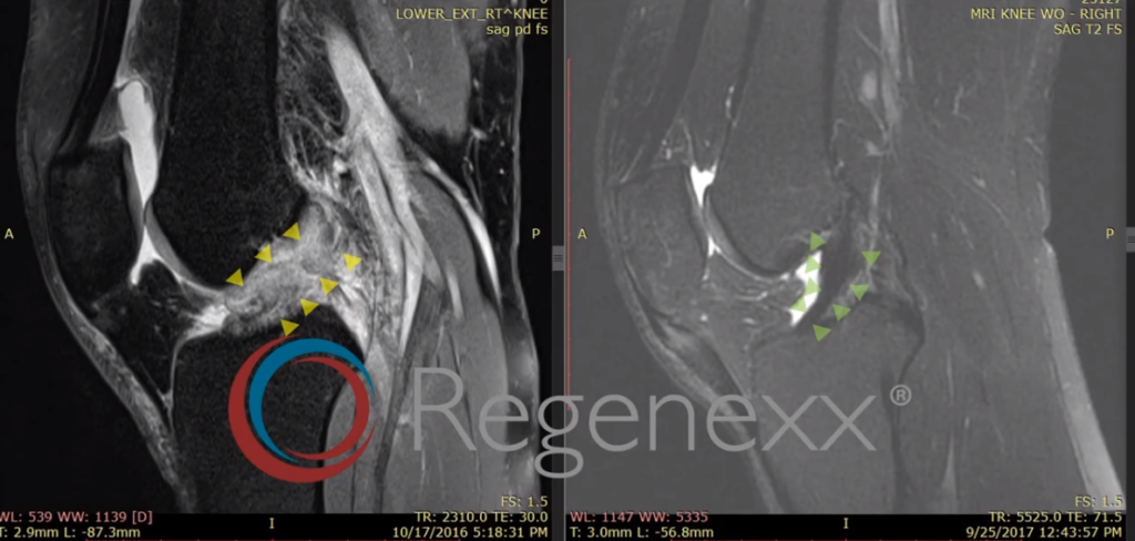 ACL MRI Evidence for the Perc-ACLR