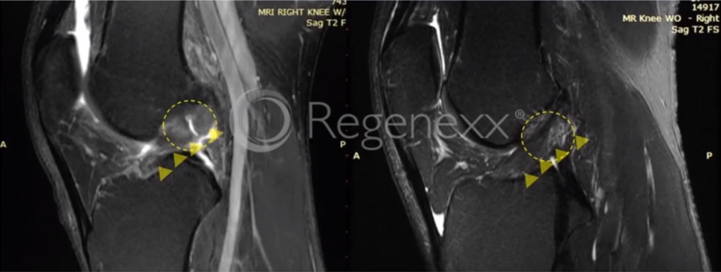 MRI of ACL before-and-after Regenexx stem cell procedure