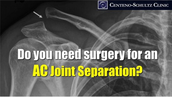 Shoulder AC Joint Separation? Think Twice About Surgery