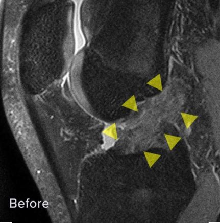 Before - acl MRI evidence for the trusted alternative to ACL surgery, the Perc-ACLR