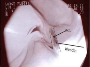 image of partial acl tear in MRI