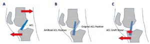 acl surgery success rate