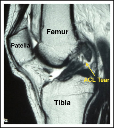 Non-Surgical Options for Your Partial ACL Tear