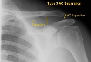 ac joint in mri