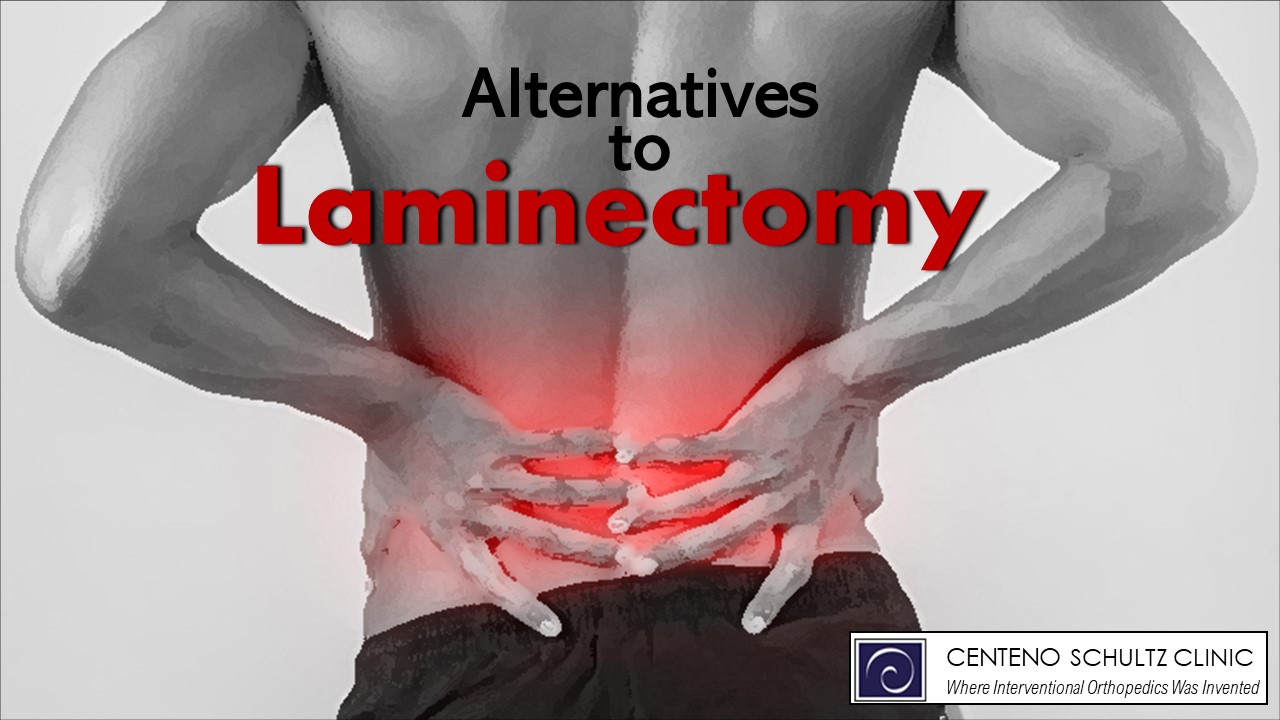 alternatives to laminectomy
