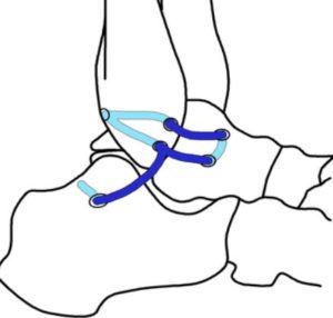 Brostrom Ankle Surgery - how the surgery operates illustration