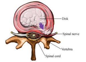 Annular Tear Expert Advice That You Need To Know