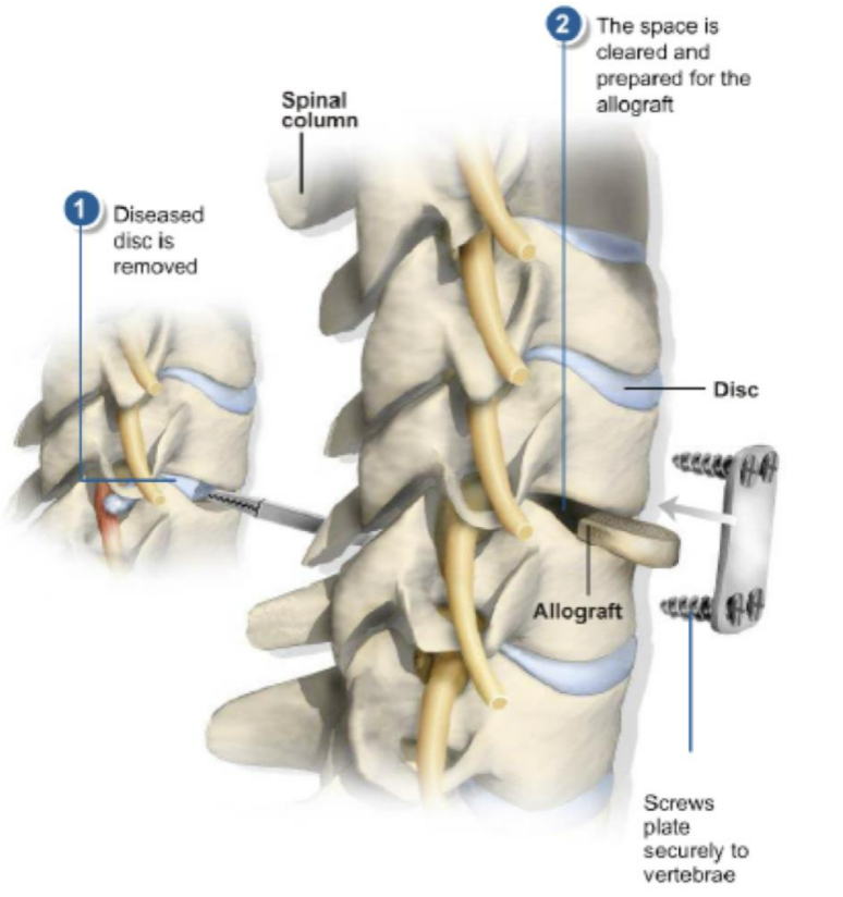 Radiculopatía cervical (nervio pinzado) (Cervical Radiculopathy (Pinched  Nerve)) - OrthoInfo - AAOS