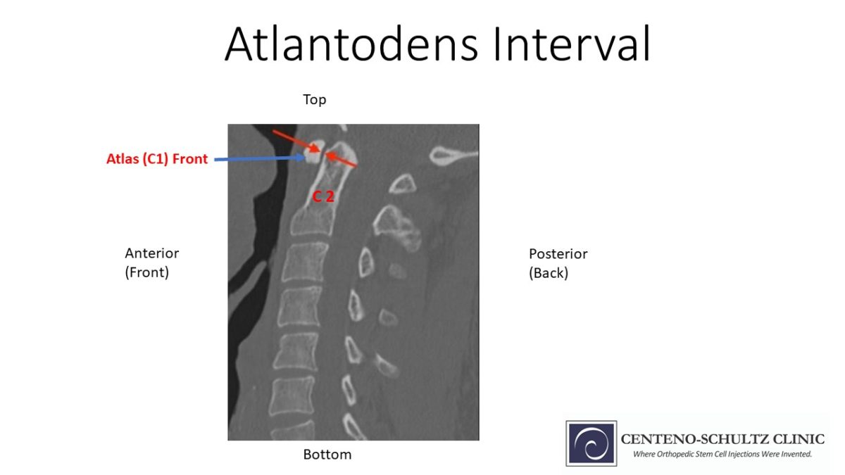 What Is The Atlantodens Interval A Quickstart Guide Csc