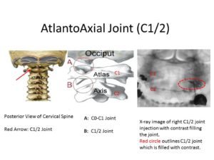AtlantoAxial Joint c1-c2
