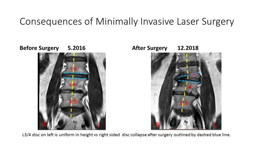 Consequences Of Minimally Invasive Spine Surgery