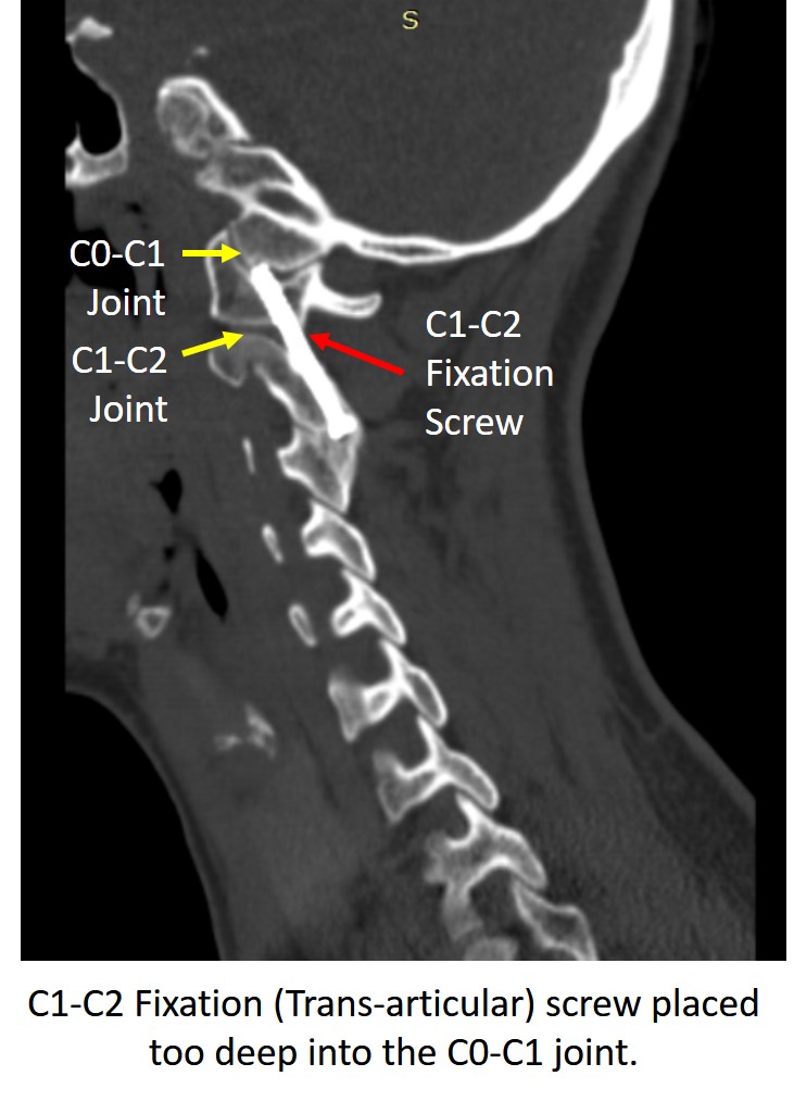 C1 C2 Fusion Complications Are Common Centeno Schultz