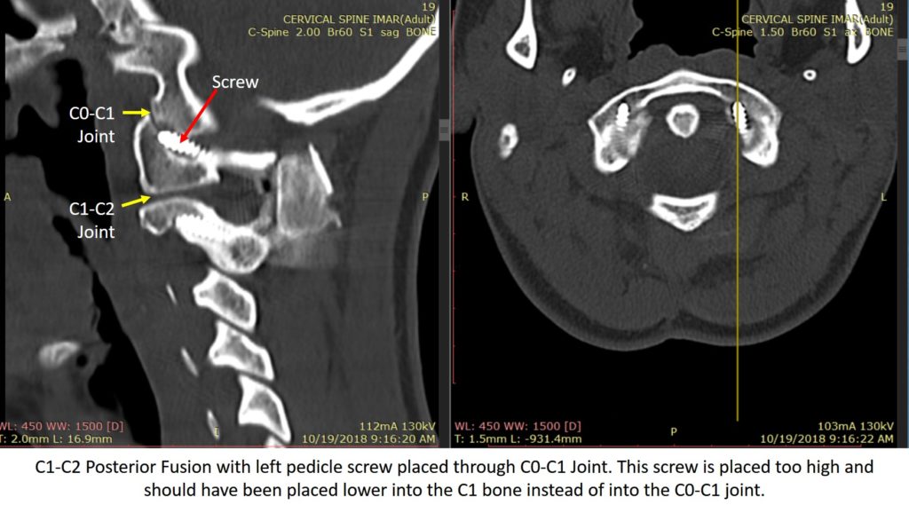 CT image of C2–3 congenital fusion. A Vertebral body fusion and