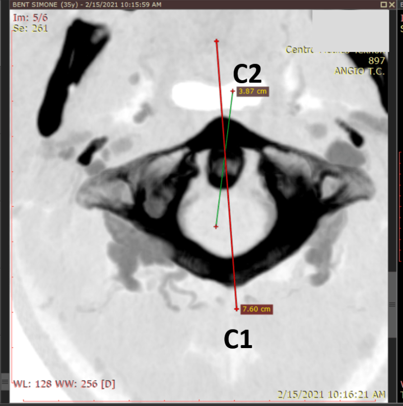 Craniocervical Junction Disorders Jugular Vein Compression