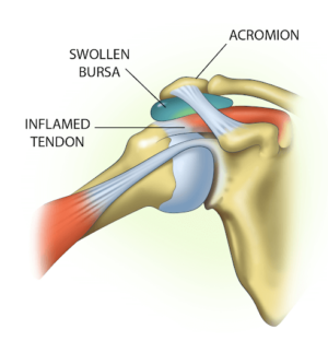 Bursitis of the Shoulder - Everything You Need to Know