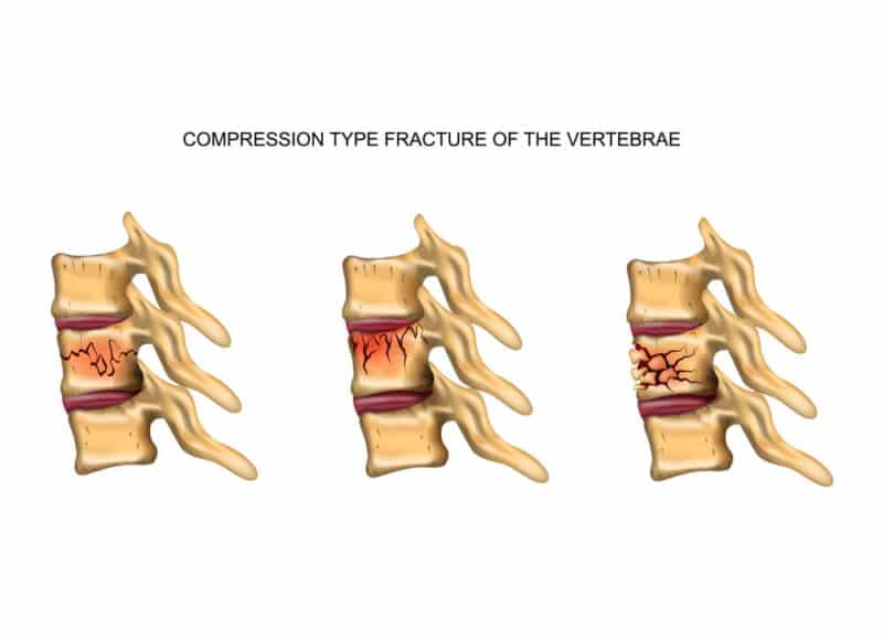 L3 Spine (3rd Lumbar Vertebra) - Anatomy, Injuries, and More