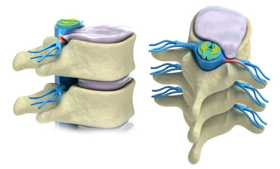 L3 Spine (3rd Lumbar Vertebra) - Anatomy, Injuries, and More