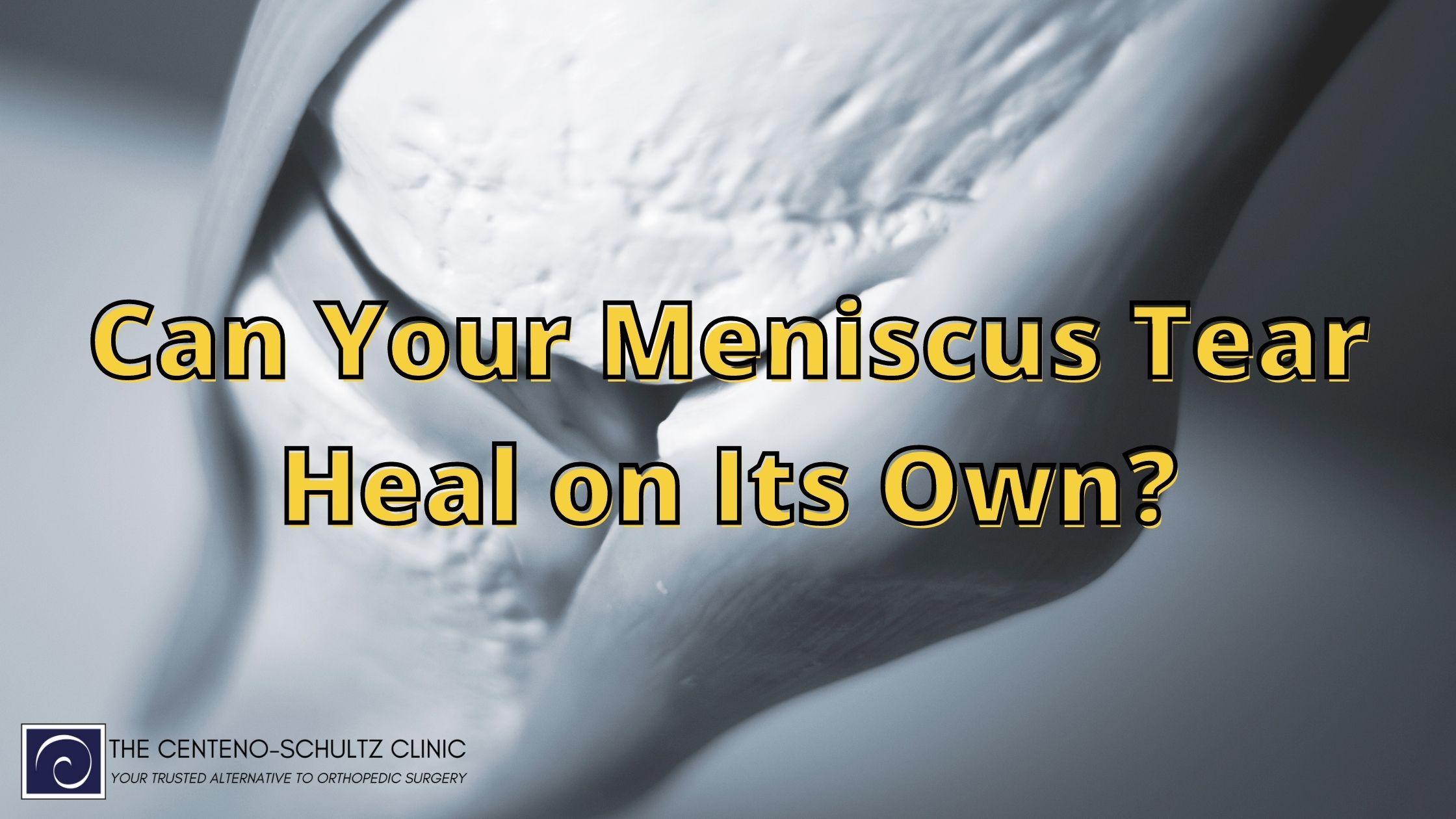 Glory Tips About How To Heal Torn Meniscus - Blockbath71