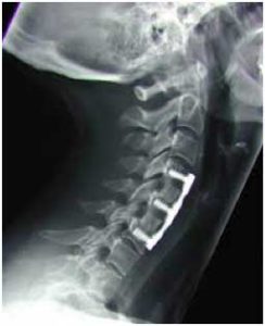 Cervical Fusion