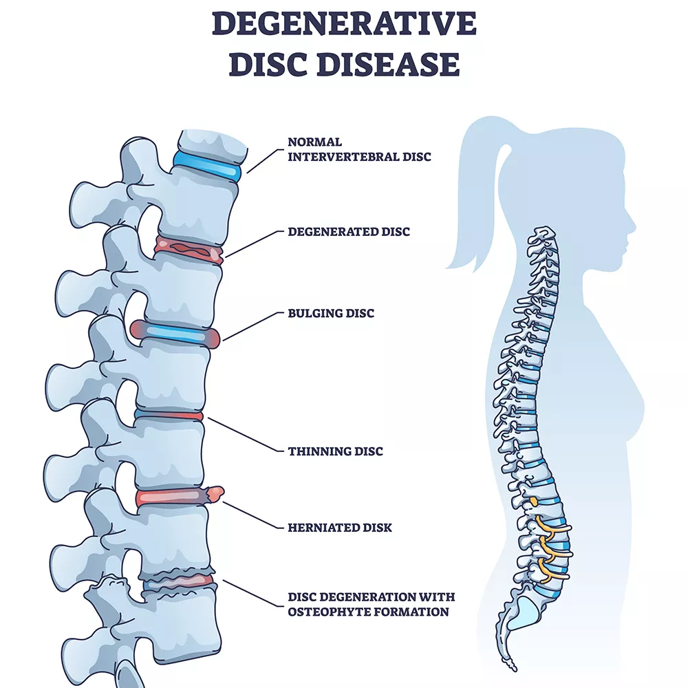 Degenerative Disc Disease