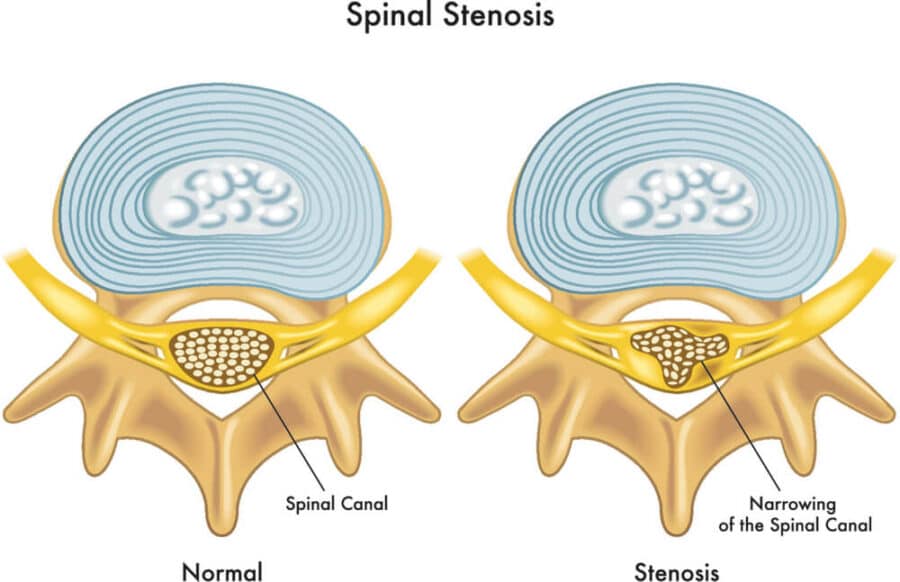 Nerve Pain in the Thoracic Spine - Causes and Treatments