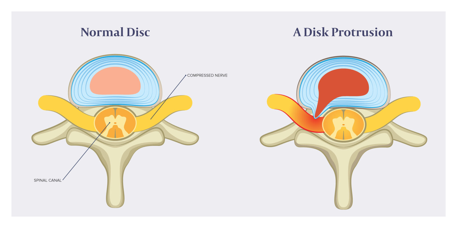 Surgery for Bulging Disc - Is It Your Best Treatment Option?