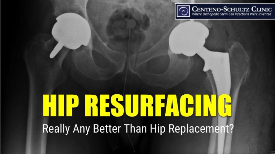 Hip Resurfacing Has Problems of Its Own CentenoSchultz