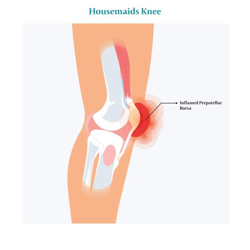 Knee Bursitis All You Need To Know Centeno Schultz Clinic 0016