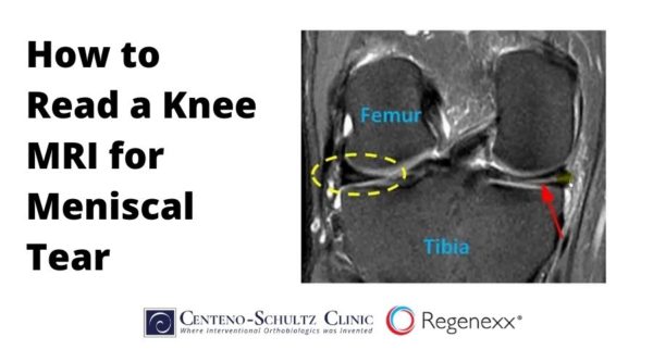 How To Read A Knee Mri For Meniscal Tear - Centeno-schultz