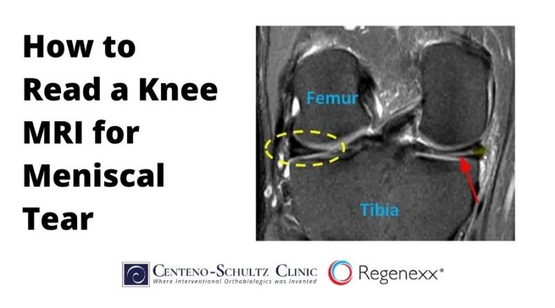 How To Read A Knee MRI For Meniscal Tear - Centeno-Schultz