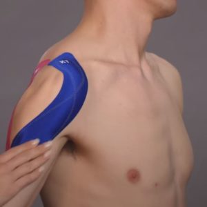Application pattern of the Kinesio Tape during the first 2 weeks